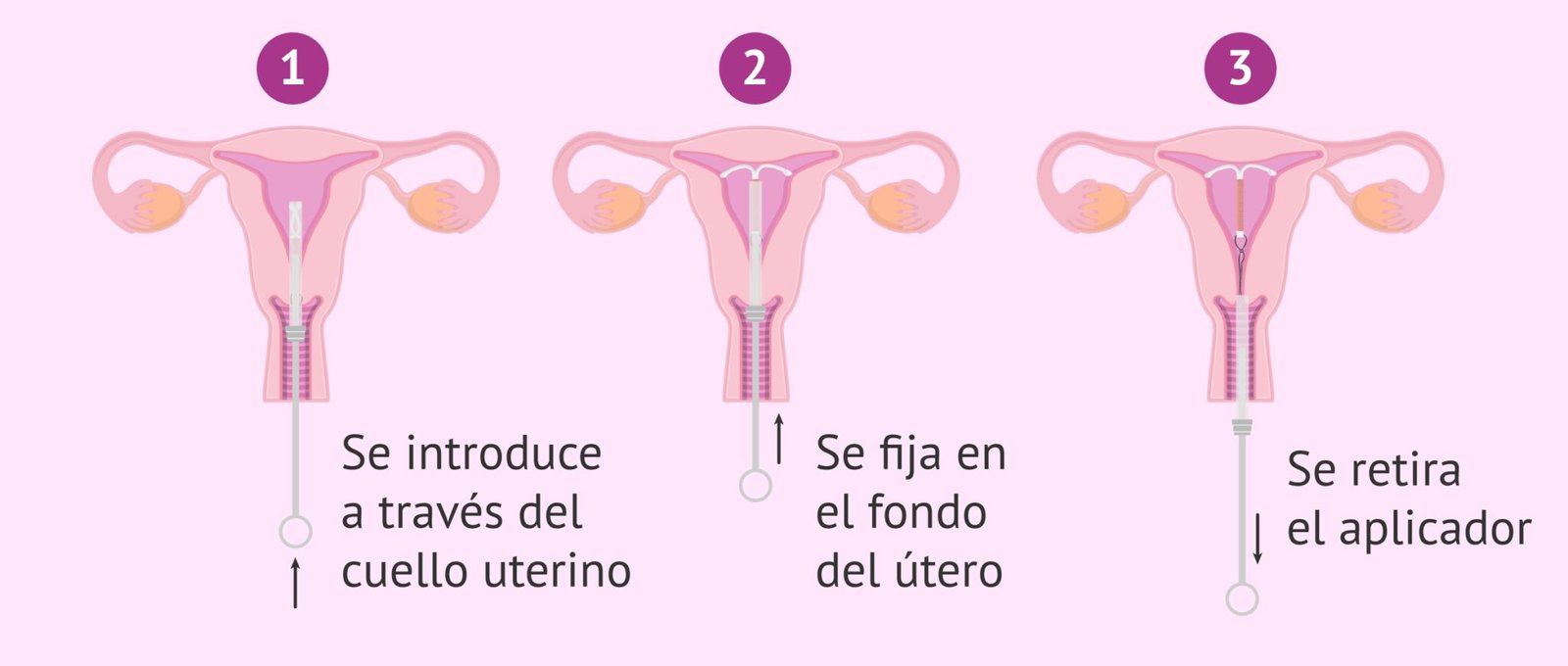 An Lisis De Las Ventajas Y Desventajas Del Diu Efectividad Beneficios