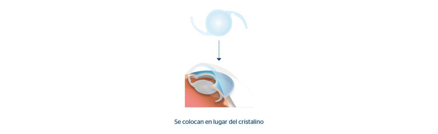 Lentes De Contacto Multifocales Un An Lisis Completo De Sus Ventajas Y