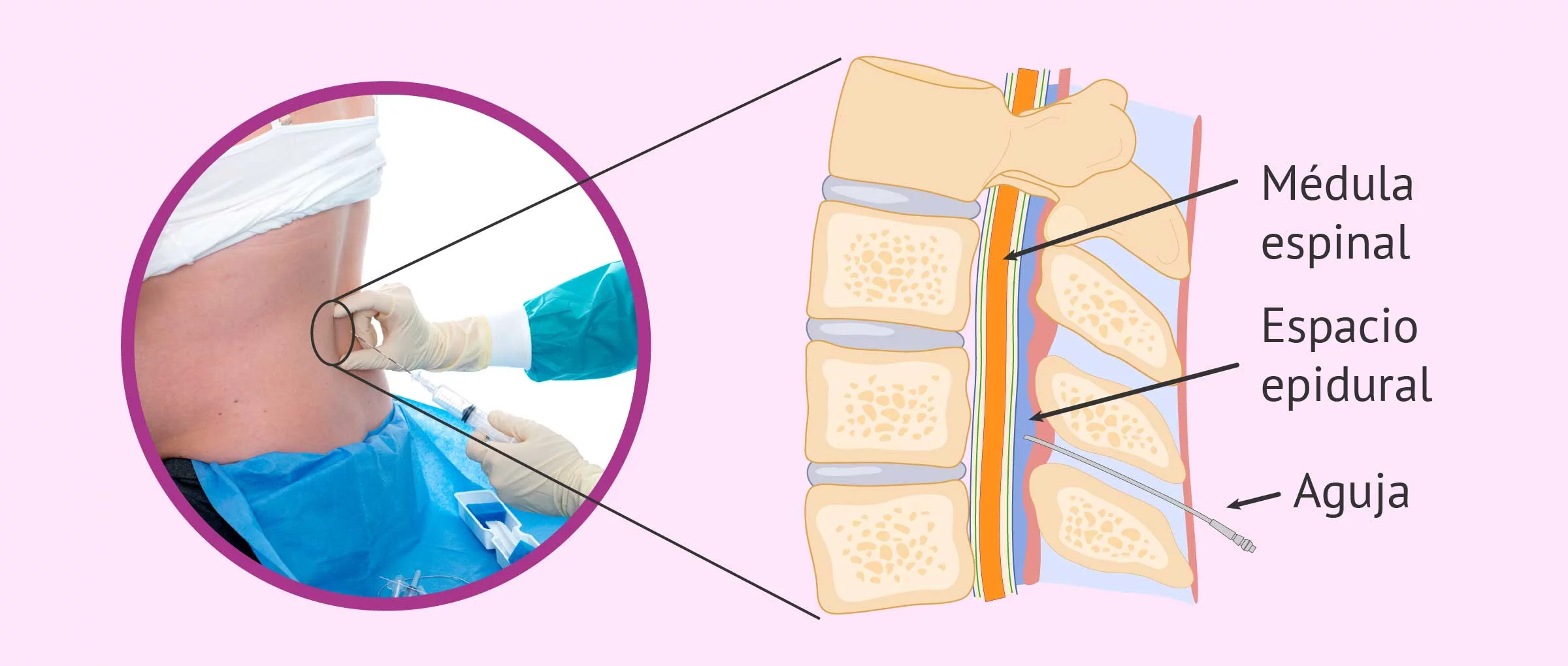 analisis-de-las-ventajas-y-desventajas-de-la-epidural-en-el-parto-todo-lo-que-necesitas-saber