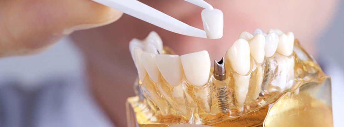analisis-de-las-ventajas-y-desventajas-de-los-implantes-dentales-todo-lo-que-debes-saber