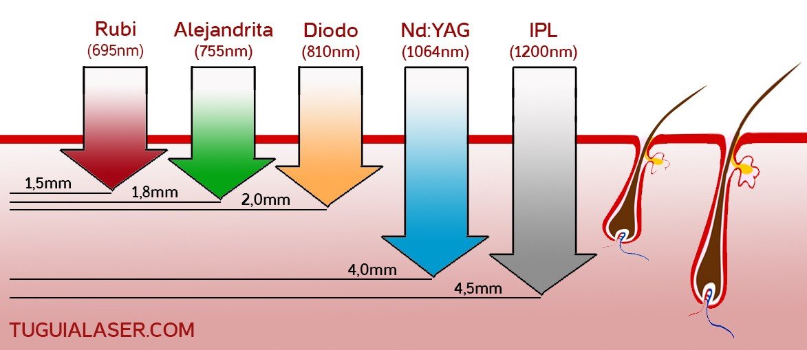 Depilación IPL: ventajas y desventajas de la luz pulsada intensadepilacion, vello, pelo, fotodepilacion, laser, IPL, luz pulsada intensa, hombres