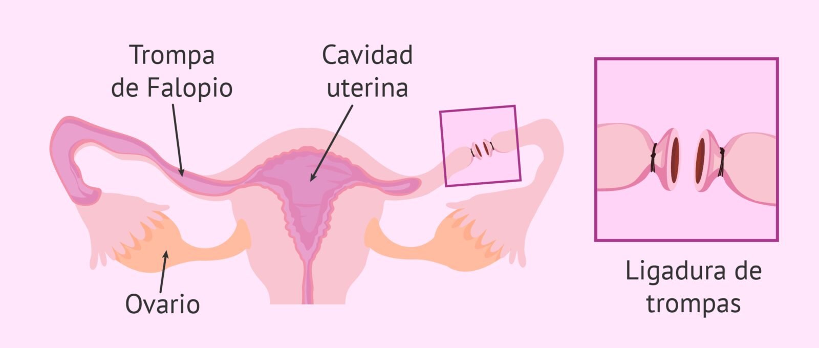 analisis-de-las-ventajas-y-desventajas-de-la-esterilizacion-laparoscopica-todo-lo-que-necesitas-saber